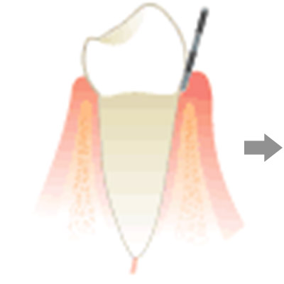  健康穩固的牙齦組織和骨頭