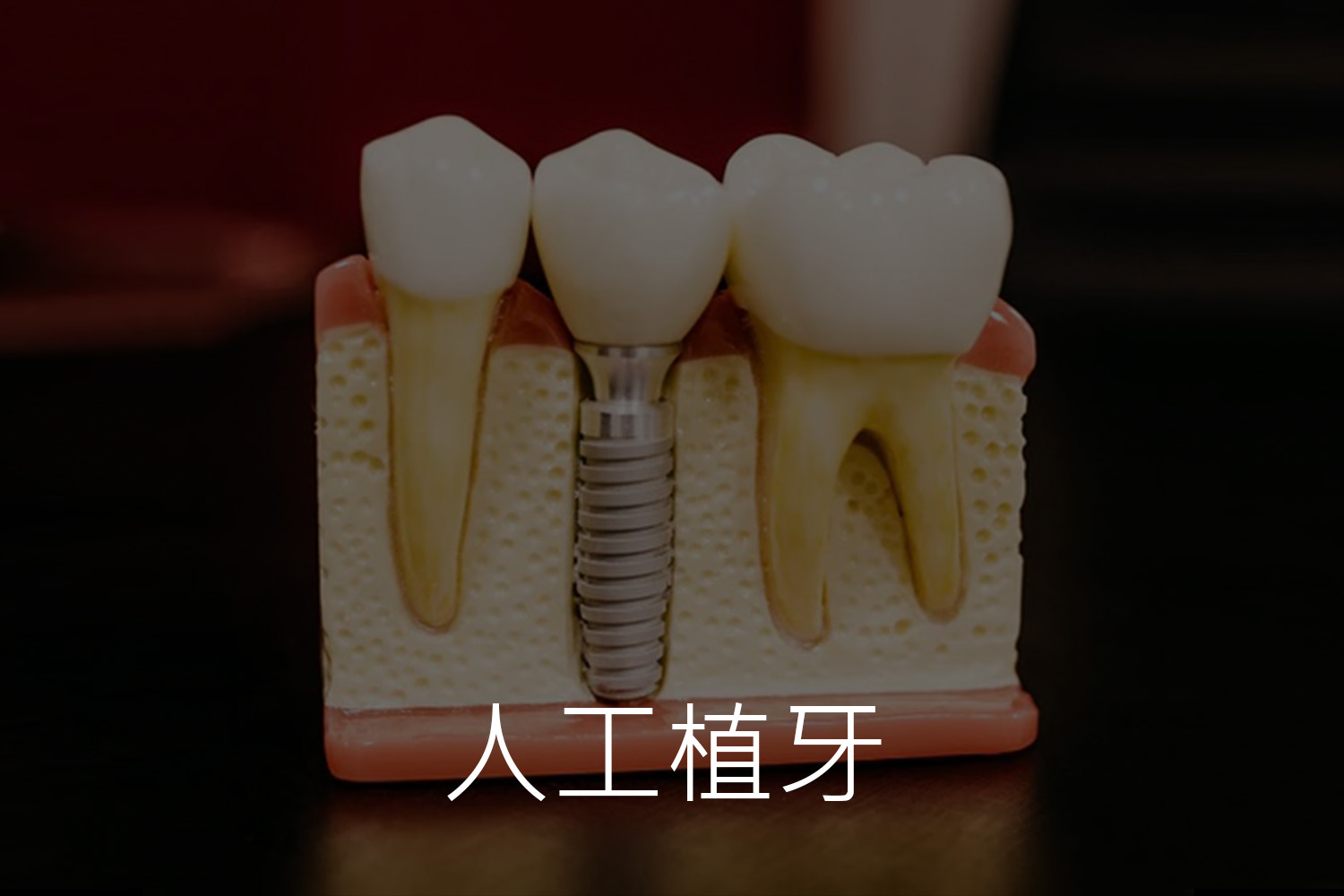 擎天牙醫 | 人工植牙